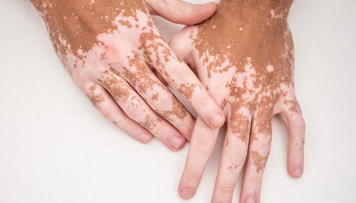 Día Mundial del Vitiligo: cuatro claves sobre esta condición que afecta la pigmentación de la piel