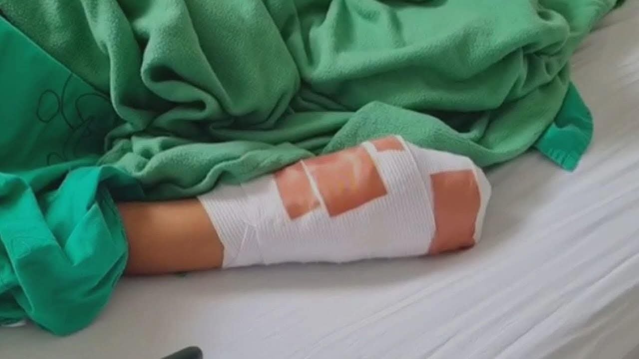 ¡Lamentable! Niño pierde la mano derecha por explosión de mortero en Roatán