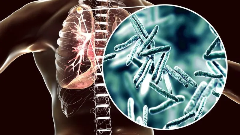 ¡Alerta! Honduras reporta 705 casos de tuberculosis en lo que va del año