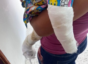 Padrastro agrede a niño de 2 años y le quema la boca con carbón en Santa Bárbara