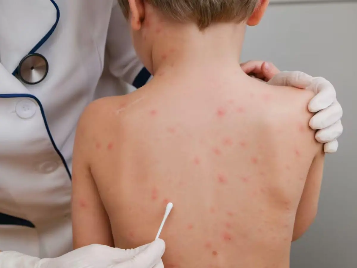 Microbiólogos advierten riesgo de epidemia de sarampión en Honduras si no aumenta la cobertura de vacunación