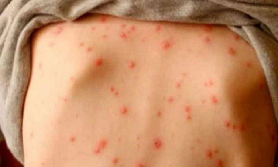 Honduras en alerta sanitaria por aumento de casos sospechosos de sarampión