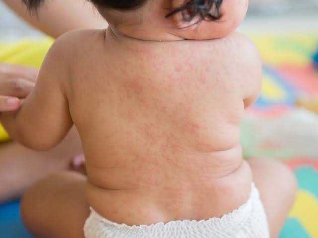 Confirman dos nuevos casos sospechosos de sarampión en lactantes de Cortés